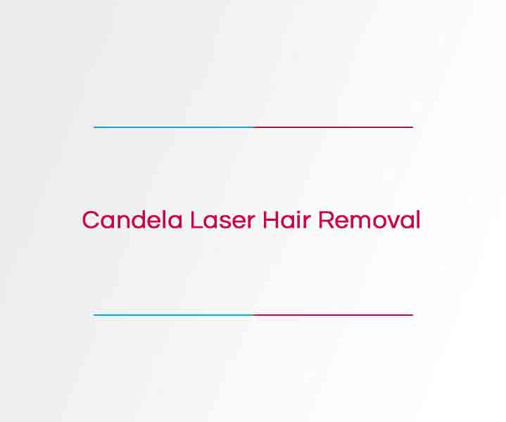 Candela-Laser-hair-removal